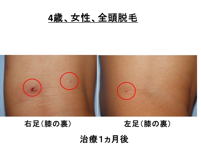 円形脱毛症　病院